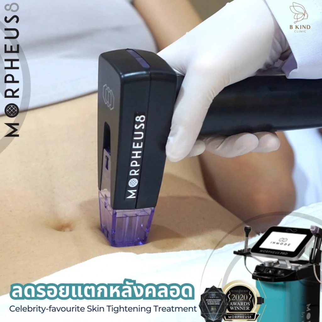 morpheus 8 ท้อง