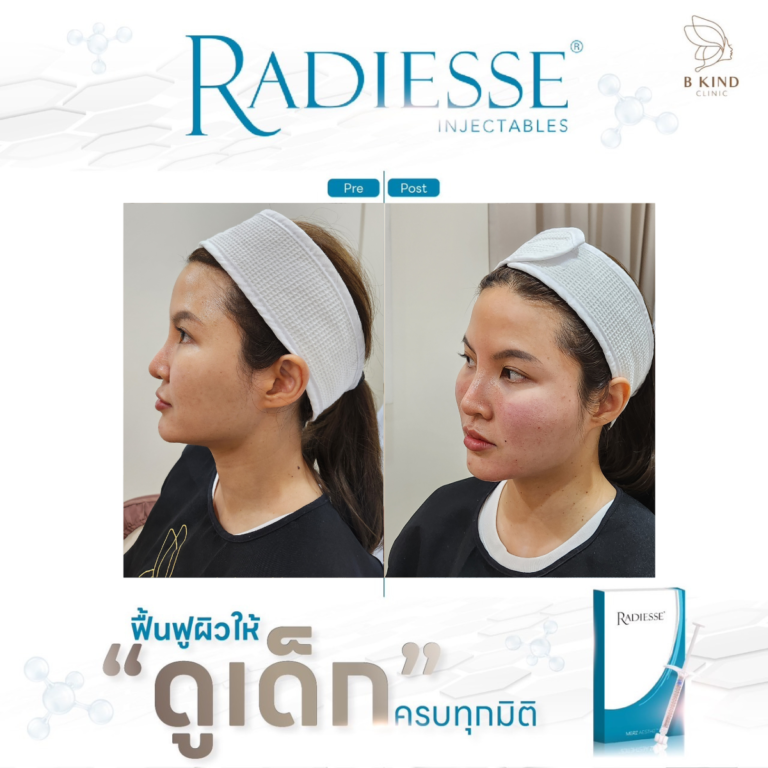 ผลลัพธ์หลังทำ RADIESSE
