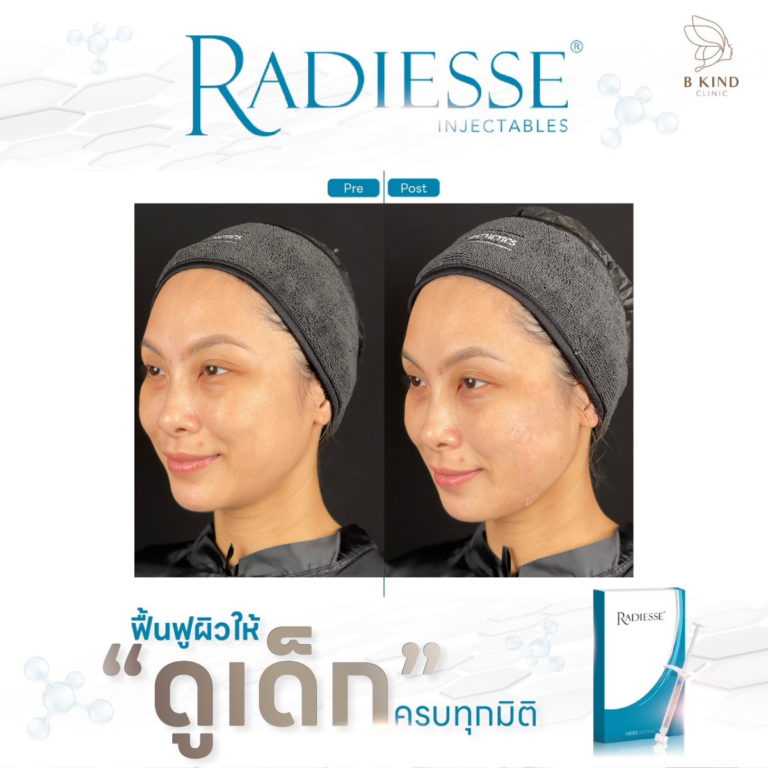 RADIESSE ดี