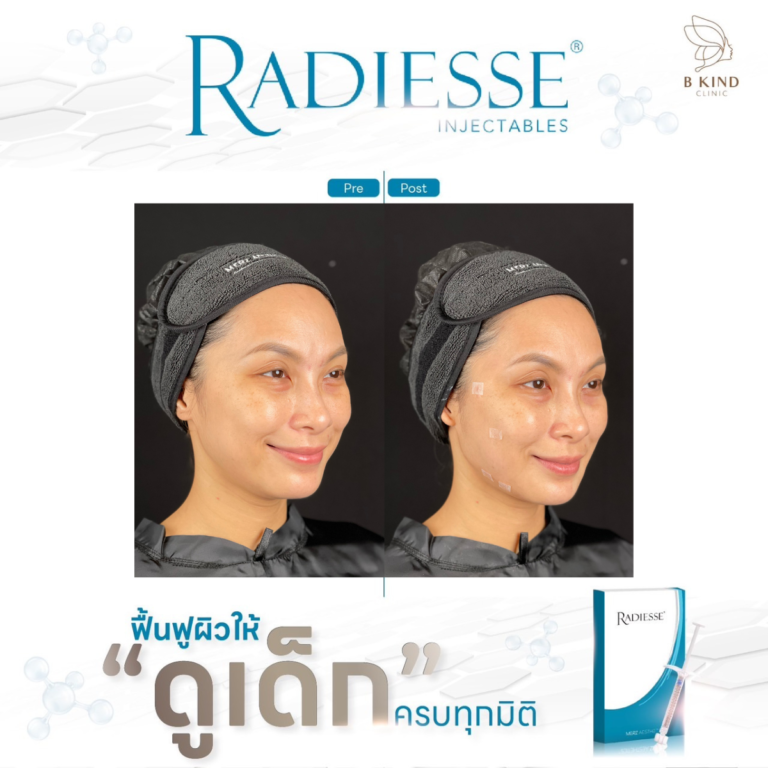 RADIESSE ที่ไหน