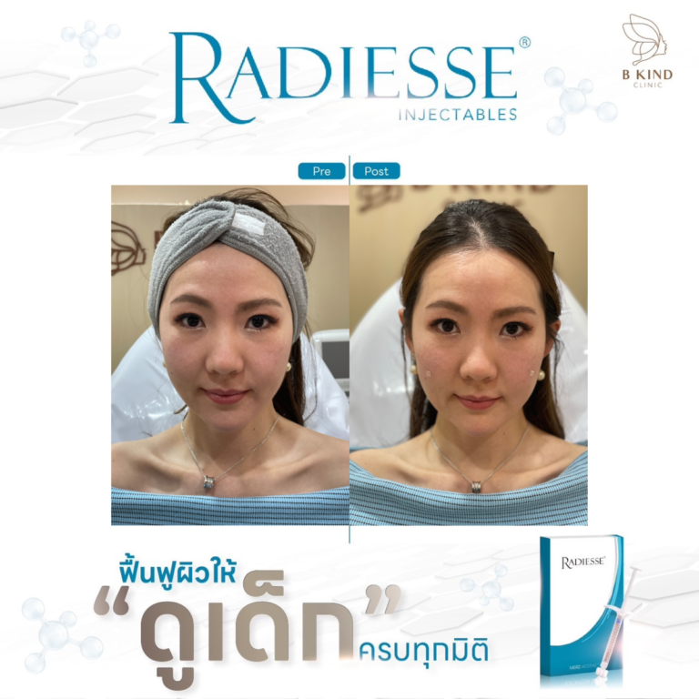 รีวิวหลังทำ RADIESSE