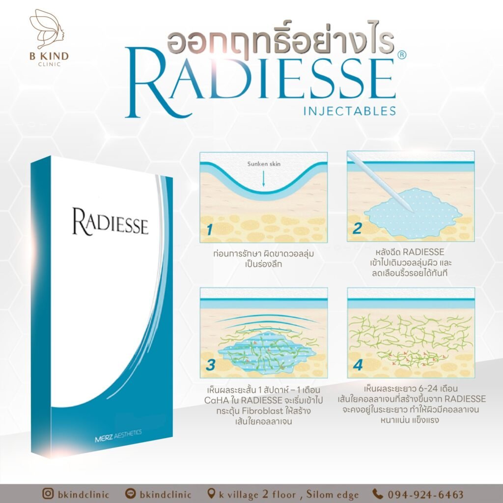 Radiesse ดีอย่างไร