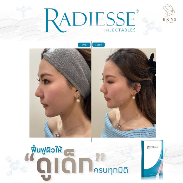 ผลลัพธ์หลังทำ RADIESSE