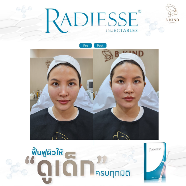 ผลลัพธ์หลังทำ RADIESSE