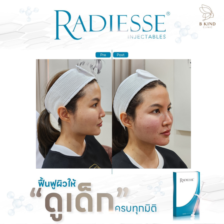 ผลลัพธ์หลังทำ RADIESSE